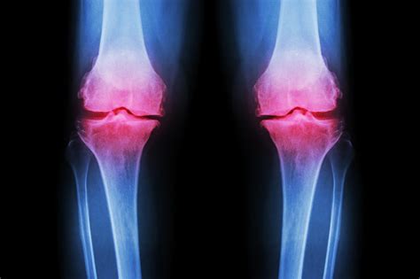 durere ascuțită în articulația genunchiului drept